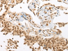 Immunohistochemistry of paraffin-embedded Human ovarian cancer tissue  using ATN1 Polyclonal Antibody at dilution of 1:50(×200)
