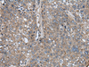 Immunohistochemistry of paraffin-embedded Human liver cancer tissue  using ARFGEF1 Polyclonal Antibody at dilution of 1:40(×200)
