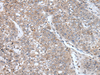 Immunohistochemistry of paraffin-embedded Human liver cancer tissue  using BORA Polyclonal Antibody at dilution of 1:105(×200)