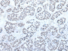 Immunohistochemistry of paraffin-embedded Human esophagus cancer tissue  using BRD3 Polyclonal Antibody at dilution of 1:60(×200)