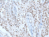 Immunohistochemistry of paraffin-embedded Human lung cancer tissue  using BRD3 Polyclonal Antibody at dilution of 1:60(×200)