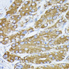 Immunohistochemistry of paraffin-embedded Human liver cancer using GRP78 / BiP Polyclonal Antibody at dilution of  1:100 (40x lens).