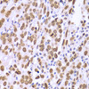 Immunohistochemistry of paraffin-embedded Human gastric cancer using Lamin A/C Polyclonal Antibody at dilution of  1:100 (40x lens).