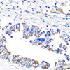 Immunohistochemistry of paraffin-embedded Human colon carcinoma using PBEF / NAMPT Polyclonal Antibody at dilution of  1:100 (40x lens).