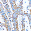 Immunohistochemistry of paraffin-embedded Human colon carcinoma using PIK3CA Polyclonal Antibody at dilution of  1:100 (40x lens).