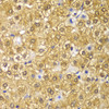 Immunohistochemistry of paraffin-embedded Human liver cancer using Cyclin D1 Polyclonal Antibody at dilution of  1:100 (40x lens).