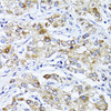 Immunohistochemistry of paraffin-embedded Human liver cancer using SOCS3 Polyclonal Antibody at dilution of  1:100 (40x lens).