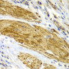 Immunohistochemistry of paraffin-embedded Human gastric cancer using CDK6 Polyclonal Antibody at dilution of  1:100 (40x lens).
