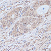 Immunohistochemistry of paraffin-embedded Human colon carcinoma using CDK9 Polyclonal Antibody at dilution of  1:100 (40x lens).