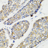 Immunohistochemistry of paraffin-embedded Human esophageal cancer using IKBKG Polyclonal Antibody at dilution of  1:100 (40x lens).