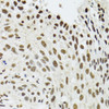 Immunohistochemistry of paraffin-embedded Human lung cancer using SFPQ Polyclonal Antibody at dilution of  1:100 (40x lens).
