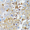 Immunohistochemistry of paraffin-embedded Human liver cancer using Caspase-1 Polyclonal Antibody at dilution of  1:100 (40x lens).