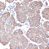 Immunohistochemistry of paraffin-embedded Human liver cancer using CytokeRatin-18 Polyclonal Antibody at dilution of  1:100 (40x lens).