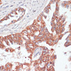 Immunohistochemistry of paraffin-embedded Human lung cancer using TIAM1 Polyclonal Antibody at dilution of  1:100 (40x lens).