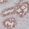 Immunohistochemistry of paraffin-embedded Human mammary cancer using TPD52 Polyclonal Antibody at dilution of  1:100 (40x lens).