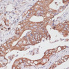 Immunohistochemistry of paraffin-embedded Human colon carcinoma using TPD52 Polyclonal Antibody at dilution of  1:100 (40x lens).