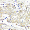 Immunohistochemistry of paraffin-embedded Human breast cancer using EIF3B Polyclonal Antibody at dilution of  1:100 (40x lens).