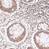 Immunohistochemistry of paraffin-embedded Human colon carcinoma using KIF14 Polyclonal Antibody at dilution of  1:100 (40x lens).