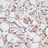 Immunohistochemistry of paraffin-embedded Human breast cancer using KIF14 Polyclonal Antibody at dilution of  1:100 (40x lens).