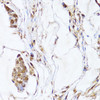 Immunohistochemistry of paraffin-embedded Human gastric cancer using EGLN1/EGLN2 Polyclonal Antibody at dilution of  1:100 (40x lens).