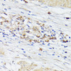 Immunohistochemistry of paraffin-embedded Human gastric cancer using TREM2 Polyclonal Antibody at dilution of  1:200 (40x lens).