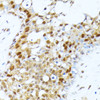 Immunohistochemistry of paraffin-embedded Human breast cancer using PRMT1 Polyclonal Antibody at dilution of  1:100 (40x lens).