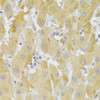 Immunohistochemistry of paraffin-embedded Human liver cancer using Slug Polyclonal Antibody at dilution of  1:100 (40x lens).