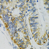 Immunohistochemistry of paraffin-embedded Human gastric cancer using SLC27A2 Polyclonal Antibody at dilution of  1:100 (40x lens).