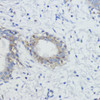 Immunohistochemistry of paraffin-embedded Human mammary cancer using AKT Polyclonal Antibody at dilution of  1:100 (40x lens).