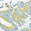 Immunohistochemistry of paraffin-embedded Human colon carcinoma using PD-L1 Polyclonal Antibody at dilution of  1:100 (40x lens).