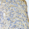 Immunohistochemistry of paraffin-embedded Human prostate cancer using APOA1 Polyclonal Antibody at dilution of  1:100 (40x lens).