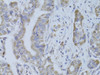 Immunohistochemistry of paraffin-embedded Human liver cancer using CDKN1A Polyclonal Antibody at dilution of  1:100 (40x lens).