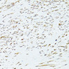 Immunohistochemistry of paraffin-embedded Human uterine cancer using TRIM15 Polyclonal Antibody at dilution of  1:100 (40x lens).