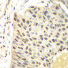 Immunohistochemistry of paraffin-embedded Human lung cancer using FEN1 Polyclonal Antibody at dilution of  1:100 (40x lens).