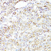 Immunohistochemistry of paraffin-embedded Human lung cancer using BAX Polyclonal Antibody at dilution of  1:100 (40x lens).
