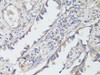 Immunohistochemistry of paraffin-embedded Human lung cancer using TrkB Polyclonal Antibody at dilution of  1:200 (40x lens).