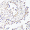 Immunohistochemistry of paraffin-embedded Human lung cancer using KL Polyclonal Antibody at dilution of  1:200 (40x lens).