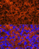 Immunofluorescence analysis of Human liver cancer using F2 Polyclonal Antibody at dilution of  1:100. Blue: DAPI for nuclear staining.