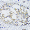 Immunohistochemistry of paraffin-embedded Human mammary cancer using SLC30A1 Polyclonal Antibody at dilution of  1:100 (40x lens).