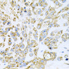 Immunohistochemistry of paraffin-embedded Human lung cancer using HDAC3 Polyclonal Antibody at dilution of  1:100 (40x lens).