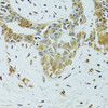 Immunohistochemistry of paraffin-embedded Human breast cancer using METTL13 Polyclonal Antibody at dilution of  1:100 (40x lens).