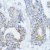 Immunohistochemistry of paraffin-embedded Human colon carcinoma using Aromatase Polyclonal Antibody at dilution of  1:100 (40x lens).