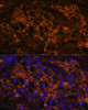 Immunofluorescence analysis of Human kidney cancer using SLC7A9 Polyclonal Antibody at dilution of  1:100. Blue: DAPI for nuclear staining.