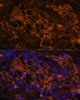 Immunofluorescence analysis of Human kidney cancer using SLC7A9 Polyclonal Antibody at dilution of  1:100. Blue: DAPI for nuclear staining.