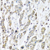 Immunohistochemistry of paraffin-embedded Human gastric cancer using IFNL3 Polyclonal Antibody at dilution of  1:100 (40x lens).