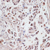 Immunohistochemistry of paraffin-embedded Human lung cancer using DKC1 Polyclonal Antibody at dilution of  1:100 (40x lens).