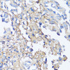 Immunohistochemistry of paraffin-embedded Human lung cancer using Fibronectin Polyclonal Antibody at dilution of  1:150 (40x lens).