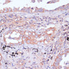 Immunohistochemistry of paraffin-embedded Human lung cancer using RPL32 Polyclonal Antibody at dilution of  1:100 (40x lens).
