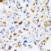 Immunohistochemistry of paraffin-embedded Human lung cancer using EP300 Polyclonal Antibody at dilution of  1:100 (40x lens).