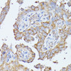 Immunohistochemistry of paraffin-embedded Human lung cancer using HAL Polyclonal Antibody at dilution of  1:100 (40x lens).